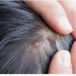 BUBULJICE NA GLAVI SU SVE ČEŠĆI PROBLEM: Ni slučajno ih ne istiskujte, evo zašto se javljaju I ŠTA TREBATE URADITI DA NESTANU